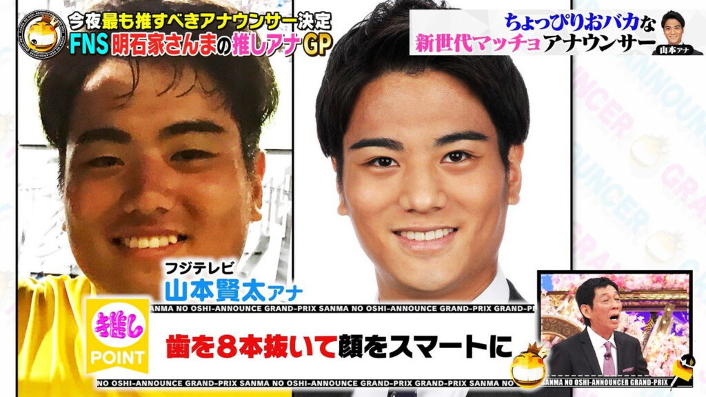 山本賢太アナ 整形 歯抜き FNS